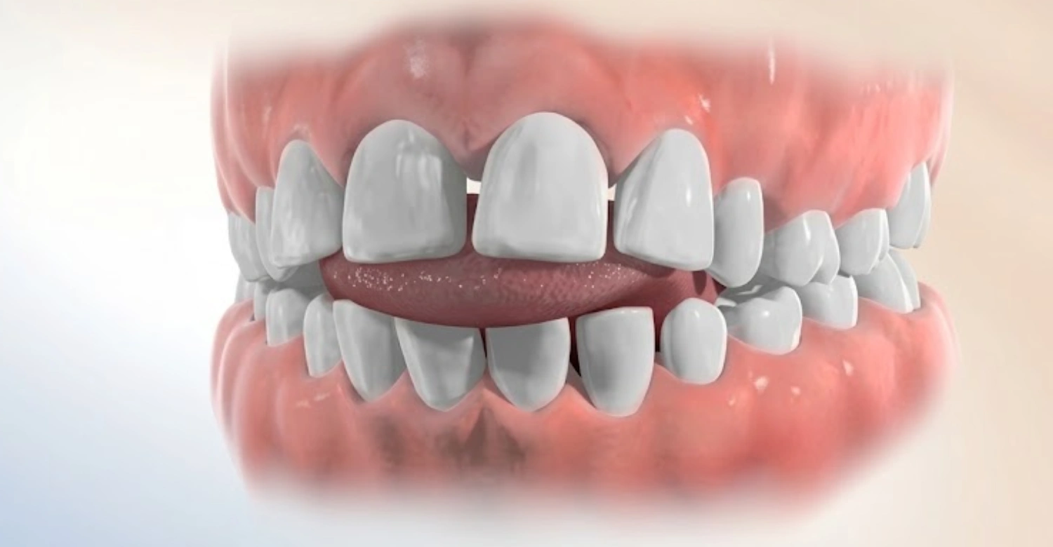 Tongue Thrust1